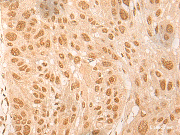 Immunohistochemistry of paraffin-embedded Human esophagus cancer tissue using DBP Polyclonal Antibody at dilution of 1:25(×200)