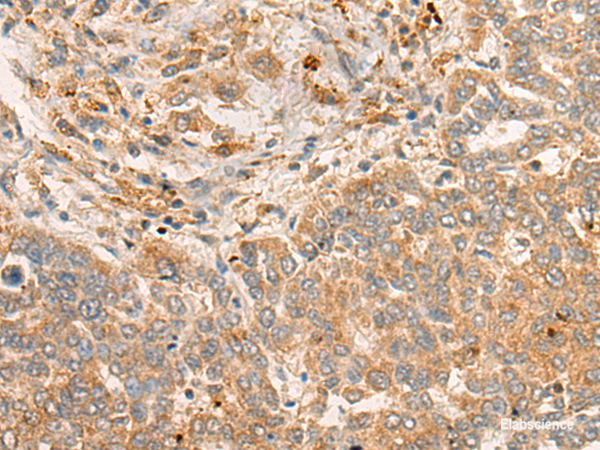 Immunohistochemistry of paraffin-embedded Human liver cancer tissue using FBXO32 Polyclonal Antibody at dilution of 1:45(×200)