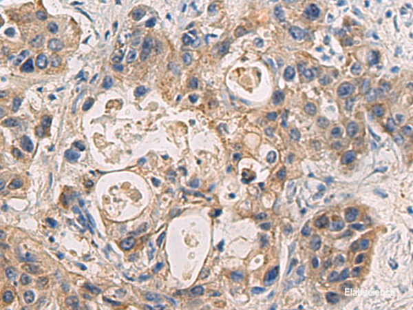 Immunohistochemistry of paraffin-embedded Human liver cancer tissue using DMRTA2 Polyclonal Antibody at dilution of 1:50(×200)