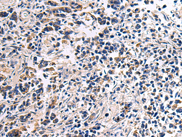 Immunohistochemistry of paraffin-embedded Human breast cancer tissue using DRGX Polyclonal Antibody at dilution of 1:45(×200)