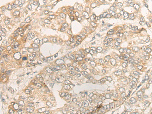 Immunohistochemistry of paraffin-embedded Human liver cancer tissue using DUOX2 Polyclonal Antibody at dilution of 1:40(×200)