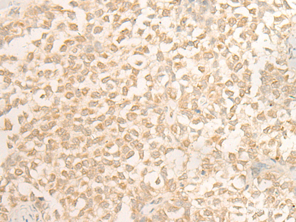 Immunohistochemistry of paraffin-embedded Human ovarian cancer tissue using DUSP27 Polyclonal Antibody at dilution of 1:50(×200)