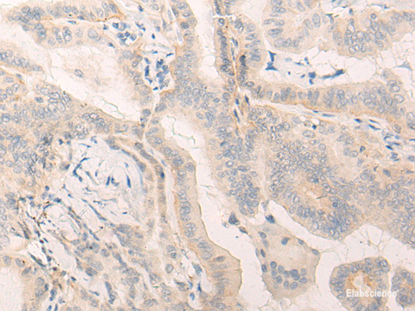 Immunohistochemistry of paraffin-embedded Human thyroid cancer tissue using ELANE Polyclonal Antibody at dilution of 1:25(×200)