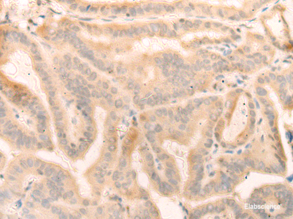 Immunohistochemistry of paraffin-embedded Human thyroid cancer tissue using ELP4 Polyclonal Antibody at dilution of 1:25(×200)