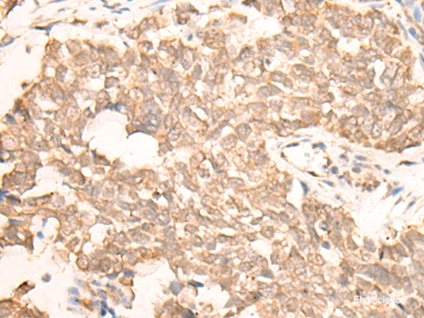 Immunohistochemistry of paraffin-embedded Human lung cancer tissue using EMSY Polyclonal Antibody at dilution of 1:25(×200)