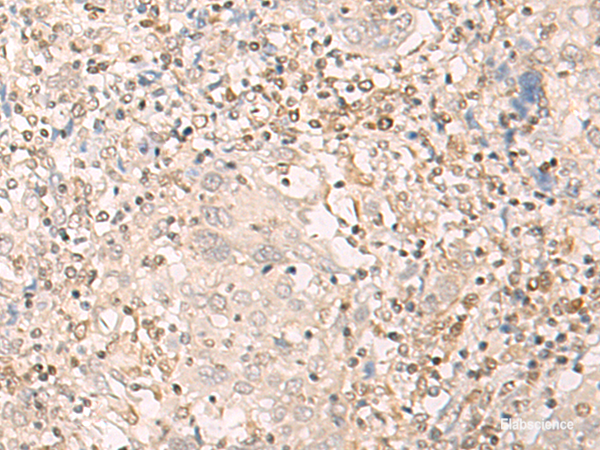 Immunohistochemistry of paraffin-embedded Human cervical cancer tissue using EPSTI1 Polyclonal Antibody at dilution of 1:25(×200)