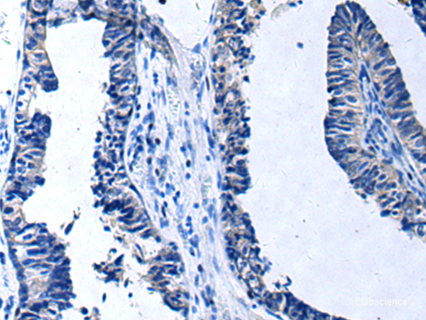 Immunohistochemistry of paraffin-embedded Human prost at e cancer tissue using PROC Polyclonal Antibody at dilution of 1:80(×200)