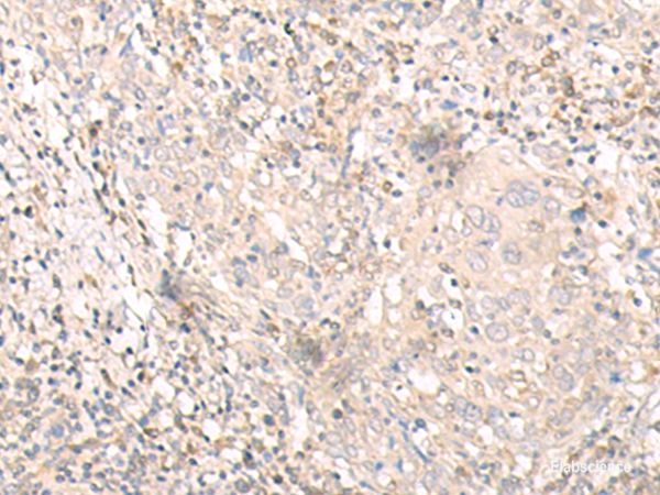 Immunohistochemistry of paraffin-embedded Human cervical cancer tissue using IL24 Polyclonal Antibody at dilution of 1:30(×200)
