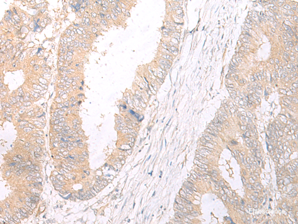 Immunohistochemistry of paraffin-embedded Human colorectal cancer tissue using HLA-C Polyclonal Antibody at dilution of 1:25(×200)