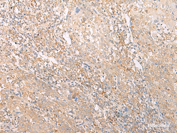 Immunohistochemistry of paraffin-embedded Human cervical cancer tissue using EPS15 Polyclonal Antibody at dilution of 1:50(×200)