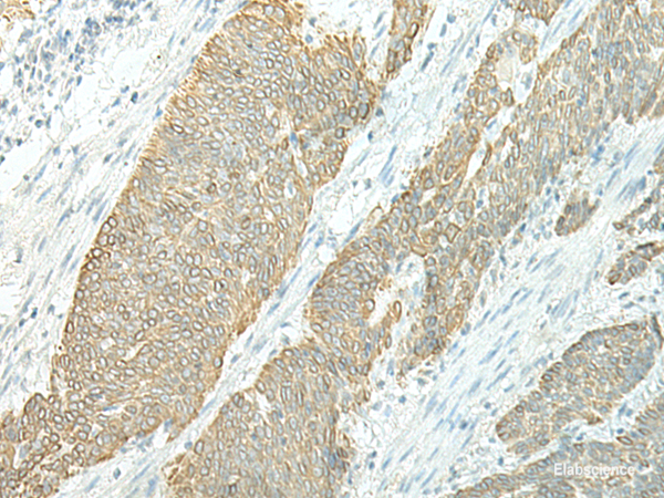 Immunohistochemistry of paraffin-embedded Human esophagus cancer tissue using ETAA1 Polyclonal Antibody at dilution of 1:25(×200)
