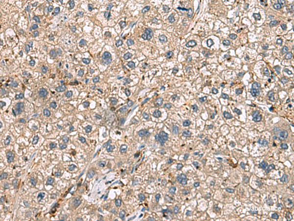 Immunohistochemistry of paraffin-embedded Human liver cancer tissue using HLA-DRA Polyclonal Antibody at dilution of 1:30(×200)