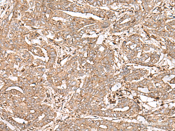 Immunohistochemistry of paraffin-embedded Human liver cancer tissue using FAAP24 Polyclonal Antibody at dilution of 1:30(×200)
