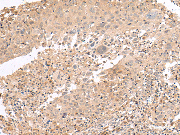 Immunohistochemistry of paraffin-embedded Human cervical cancer tissue using PATJ Polyclonal Antibody at dilution of 1:45(×200)