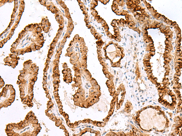 Immunohistochemistry of paraffin-embedded Human thyroid cancer tissue using SAXO2 Polyclonal Antibody at dilution of 1:40(×200)