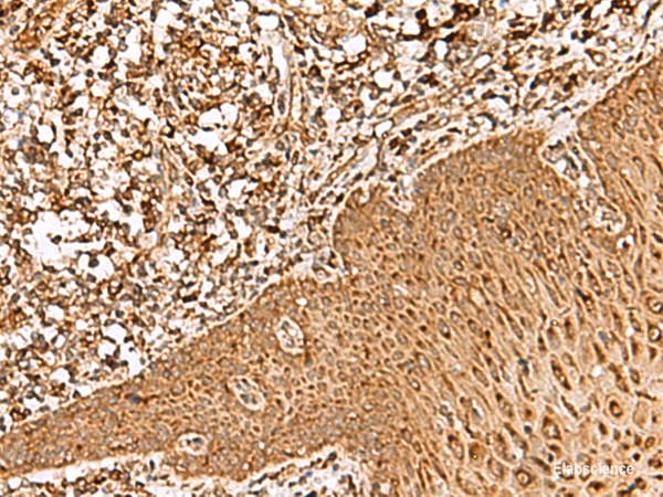 Immunohistochemistry of paraffin-embedded Human esophagus cancer tissue using FAM200A Polyclonal Antibody at dilution of 1:55(×200)