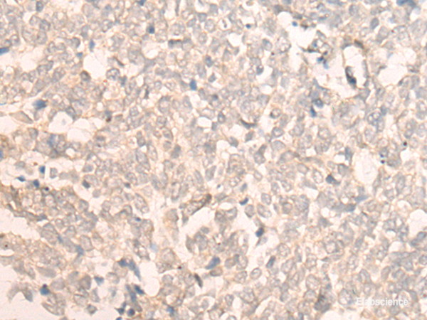 Immunohistochemistry of paraffin-embedded Human lung cancer tissue using FAN1 Polyclonal Antibody at dilution of 1:30(×200)
