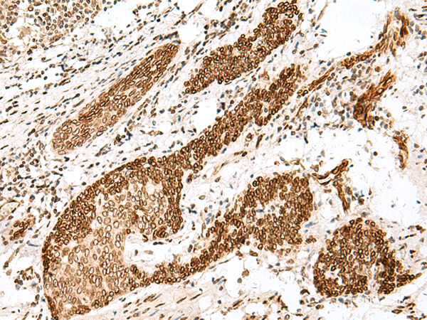 Immunohistochemistry of paraffin-embedded Human esophagus cancer tissue using FANCB Polyclonal Antibody at dilution of 1:25(×200)
