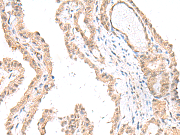 Immunohistochemistry of paraffin-embedded Human thyroid cancer tissue using FANCE Polyclonal Antibody at dilution of 1:50(×200)