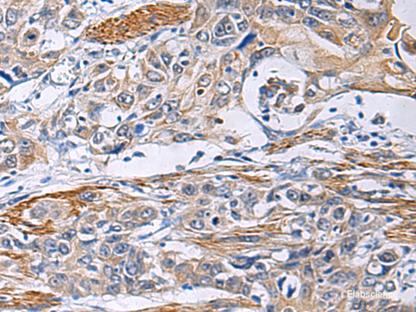 Immunohistochemistry of paraffin-embedded Human esophagus cancer tissue using FBXO45 Polyclonal Antibody at dilution of 1:40(×200)