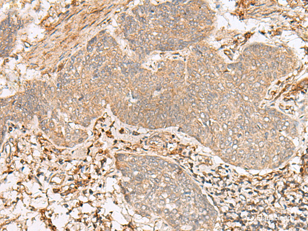 Immunohistochemistry of paraffin-embedded Human esophagus cancer tissue using FBXW8 Polyclonal Antibody at dilution of 1:65(×200)