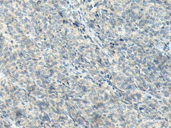 Immunohistochemistry of paraffin-embedded Human ovarian cancer tissue using NPVF Polyclonal Antibody at dilution of 1:80(×200)