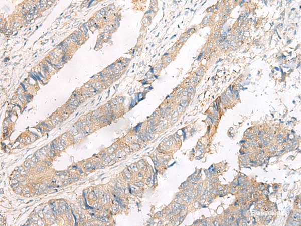 Immunohistochemistry of paraffin-embedded Human colorectal cancer tissue using FERD3L Polyclonal Antibody at dilution of 1:75(×200)