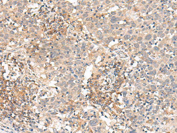 Immunohistochemistry of paraffin-embedded Human cervical cancer tissue using SLC40A1 Polyclonal Antibody at dilution of 1:90(×200)