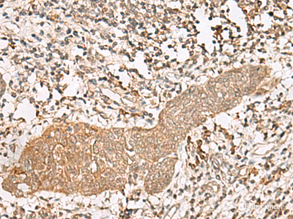 Immunohistochemistry of paraffin-embedded Human esophagus cancer tissue using FGF13 Polyclonal Antibody at dilution of 1:45(×200)
