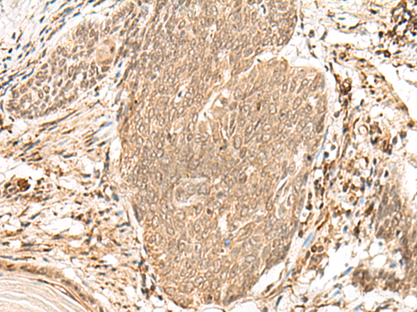 Immunohistochemistry of paraffin-embedded Human esophagus cancer tissue using VPS50 Polyclonal Antibody at dilution of 1:45(×200)