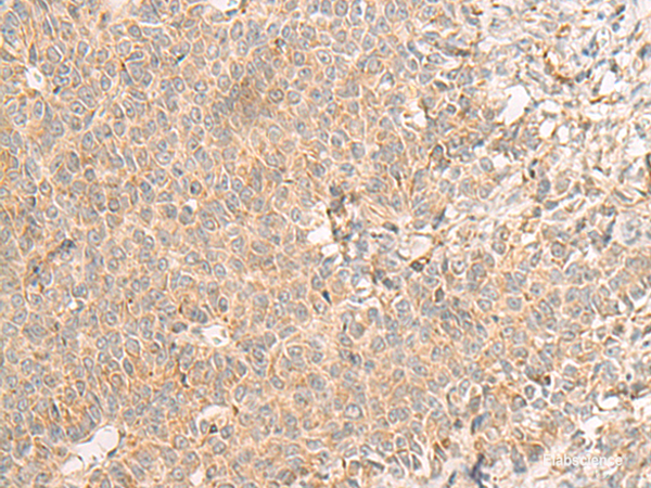 Immunohistochemistry of paraffin-embedded Human ovarian cancer tissue using RNF207 Polyclonal Antibody at dilution of 1:40(×200)