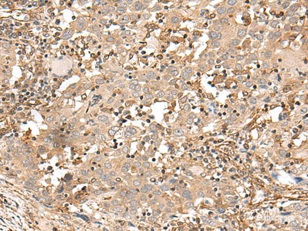 Immunohistochemistry of paraffin-embedded Human cervical cancer tissue using FSTL5 Polyclonal Antibody at dilution of 1:50(×200)