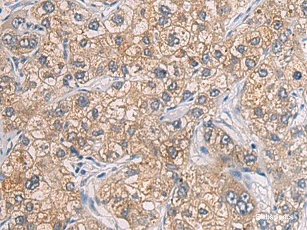 Immunohistochemistry of paraffin-embedded Human liver cancer tissue using GAB4 Polyclonal Antibody at dilution of 1:60(×200)