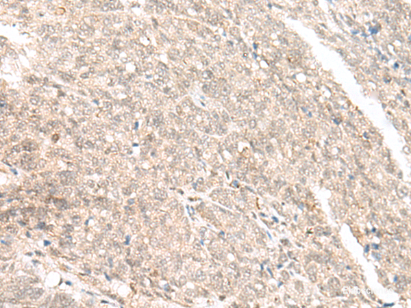 Immunohistochemistry of paraffin-embedded Human ovarian cancer tissue using GANC Polyclonal Antibody at dilution of 1:45(×200)