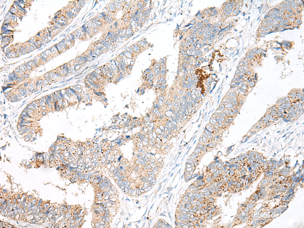 Immunohistochemistry of paraffin-embedded Human colorectal cancer tissue using GARNL3 Polyclonal Antibody at dilution of 1:60(×200)