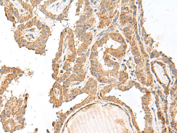 Immunohistochemistry of paraffin-embedded Human thyroid cancer tissue using GART Polyclonal Antibody at dilution of 1:30(×200)