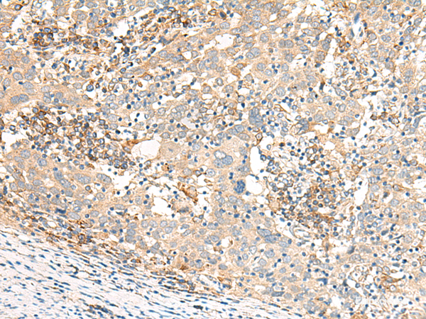 Immunohistochemistry of paraffin-embedded Human cervical cancer tissue using GBP4 Polyclonal Antibody at dilution of 1:30(×200)