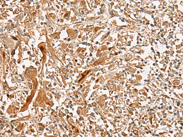 Immunohistochemistry of paraffin-embedded Human liver cancer tissue using GCC2 Polyclonal Antibody at dilution of 1:45(×200)
