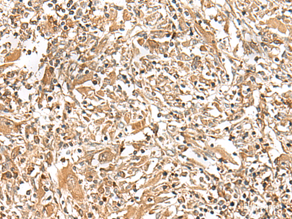 Immunohistochemistry of paraffin-embedded Human liver cancer tissue using GEMIN4 Polyclonal Antibody at dilution of 1:30(×200)