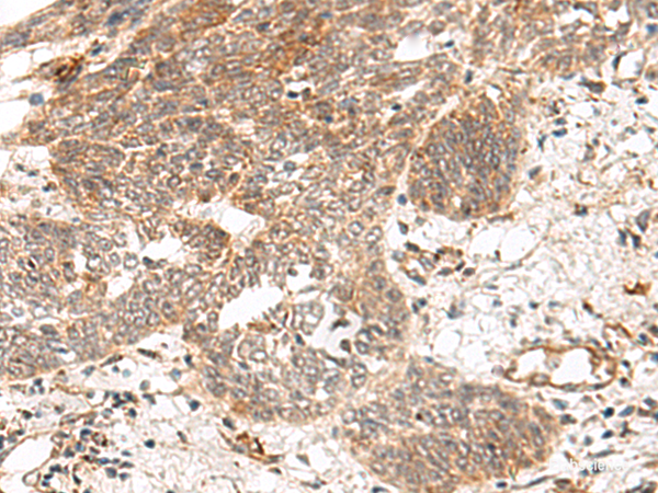 Immunohistochemistry of paraffin-embedded Human esophagus cancer tissue using GRASP Polyclonal Antibody at dilution of 1:150(×200)