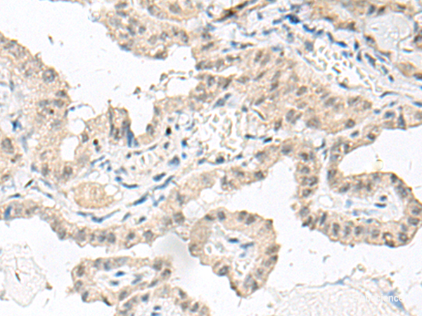 Immunohistochemistry of paraffin-embedded Human thyroid cancer tissue using GFI1B Polyclonal Antibody at dilution of 1:80(×200)