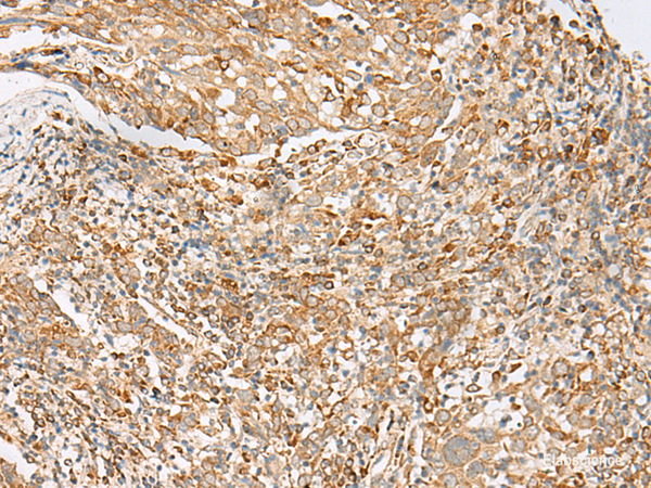 Immunohistochemistry of paraffin-embedded Human cervical cancer tissue using MBOAT4 Polyclonal Antibody at dilution of 1:30(×200)