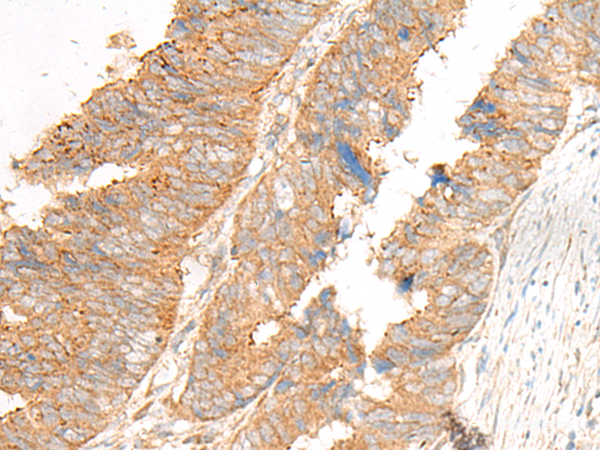 Immunohistochemistry of paraffin-embedded Human colorectal cancer tissue using GLIS1 Polyclonal Antibody at dilution of 1:50(×200)
