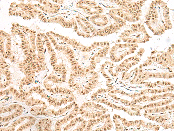 Immunohistochemistry of paraffin-embedded Human thyroid cancer tissue using BICRA Polyclonal Antibody at dilution of 1:40(×200)