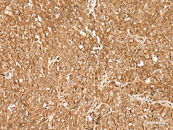 Immunohistochemistry of paraffin-embedded Human ovarian cancer tissue using GMEB2 Polyclonal Antibody at dilution of 1:35(×200)
