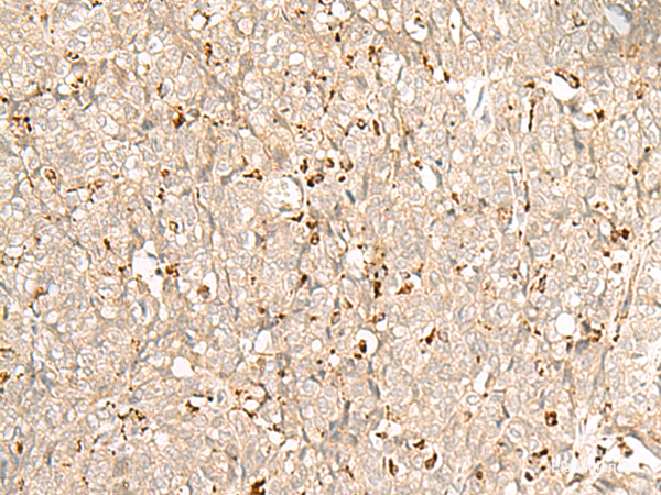 Immunohistochemistry of paraffin-embedded Human ovarian cancer tissue using NUP210 Polyclonal Antibody at dilution of 1:30(×200)