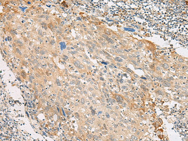 Immunohistochemistry of paraffin-embedded Human cervical cancer tissue using GPR151 Polyclonal Antibody at dilution of 1:45(×200)