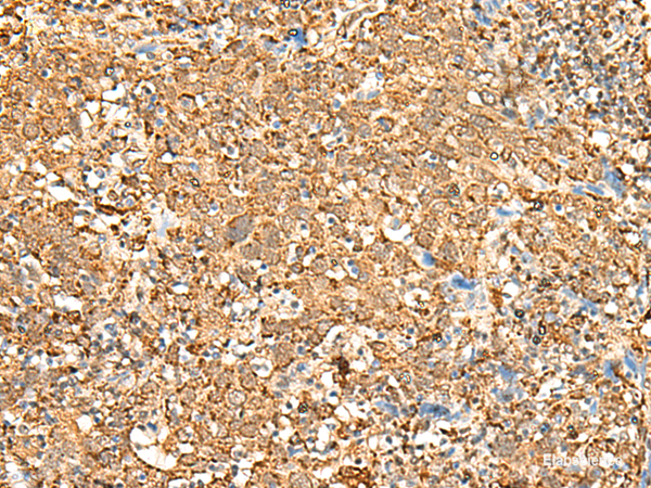 Immunohistochemistry of paraffin-embedded Human cervical cancer tissue using P2RY14 Polyclonal Antibody at dilution of 1:25(×200)