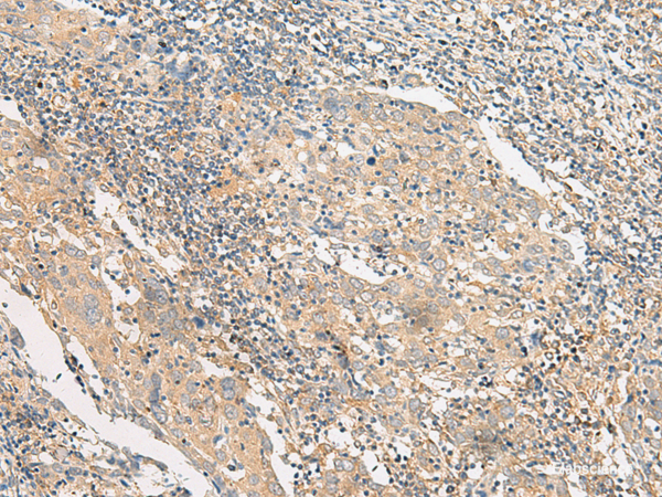 Immunohistochemistry of paraffin-embedded Human cervical cancer tissue using POLR2L Polyclonal Antibody at dilution of 1:45(×200)