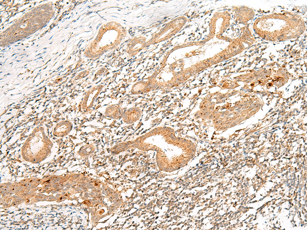Immunohistochemistry of paraffin-embedded Human esophagus cancer tissue using HLA-G Polyclonal Antibody at dilution of 1:45(×200)